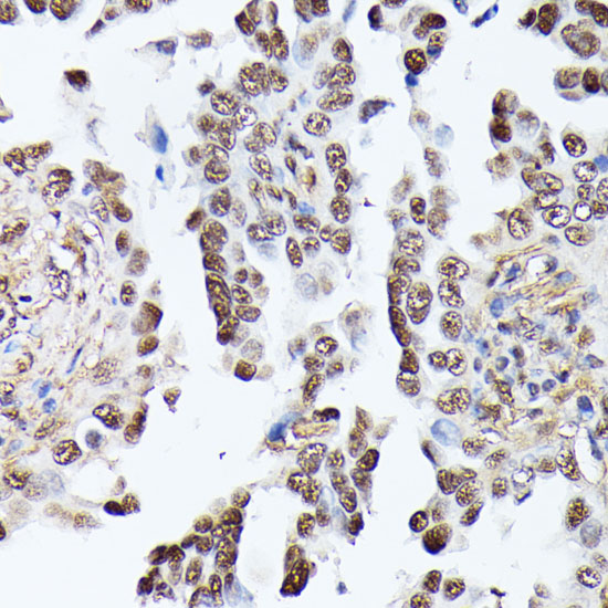 Immunohistochemistry of paraffin-embedded Human lung cancer using TPI1 Polyclonal Antibody at dilution of  1:100 (40x lens).