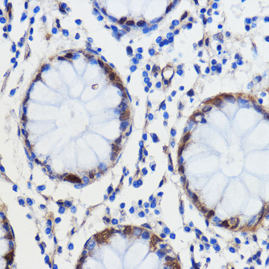 Immunohistochemistry of paraffin-embedded Human colon carcinoma using GCAT Polyclonal Antibody at dilution of  1:100 (40x lens).