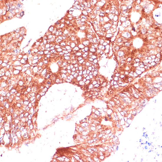 Immunohistochemistry of paraffin-embedded Human colon carcinoma using FAM98A Polyclonal Antibody at dilution of  1:100 (40x lens).