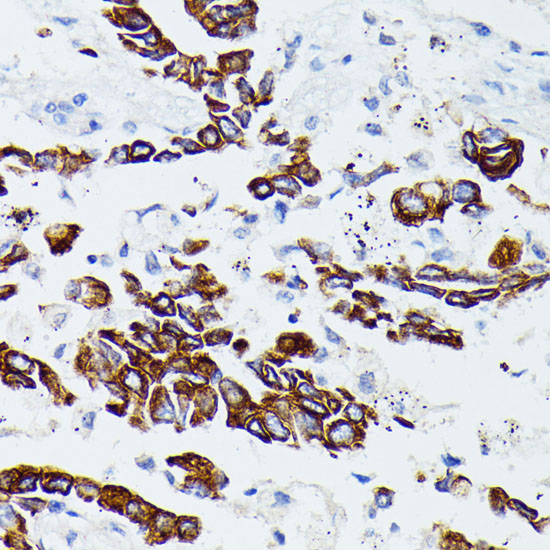 Immunohistochemistry of paraffin-embedded Human lung cancer using MMP25 Polyclonal Antibody at dilution of  1:100 (40x lens).