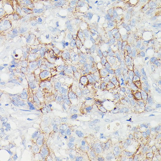 Immunohistochemistry of paraffin-embedded Human lymph node tumors using SLC14A1 Polyclonal Antibody at dilution of  1:100 (40x lens).