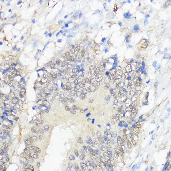 Immunohistochemistry of paraffin-embedded Human colon carcinoma using GPX2 Polyclonal Antibody at dilution of  1:100 (40x lens).