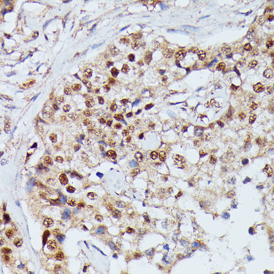 Immunohistochemistry of paraffin-embedded Human mammary cancer using IGHMBP2 Polyclonal Antibody at dilution of  1:100 (40x lens).