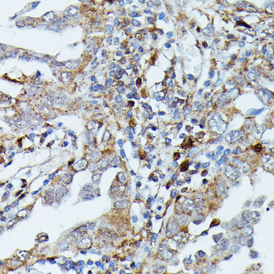 Immunohistochemistry of paraffin-embedded Human lung cancer using MAP3K3 Polyclonal Antibody at dilution of  1:100 (40x lens).