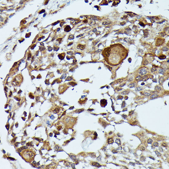 Immunohistochemistry of paraffin-embedded Human esophageal cancer using MAP3K3 Polyclonal Antibody at dilution of  1:100 (40x lens).