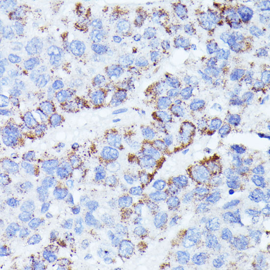 Immunohistochemistry of paraffin-embedded Human liver cancer using CCDC6 Polyclonal Antibody at dilution of  1:100 (40x lens).