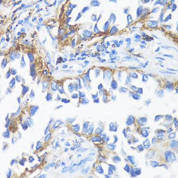 Immunohistochemistry of paraffin-embedded Human lung cancer using HLA-DRB3 Polyclonal Antibody at dilution of  1:100 (40x lens).