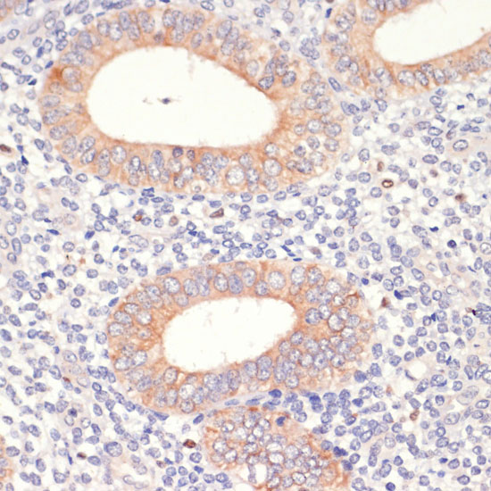 Immunohistochemistry of paraffin-embedded Human uterine cancer using HMGCR Polyclonal Antibody at dilution of  1:200 (40x lens).