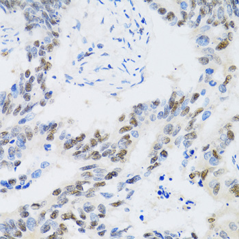 Immunohistochemistry of paraffin-embedded Human colon carcinoma using CDK6 Polyclonal Antibody at dilution of  1:100 (40x lens).