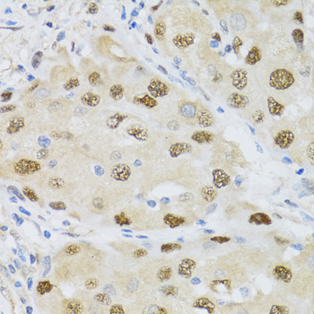 Immunohistochemistry of paraffin-embedded Human breast cancer using CDK6 Polyclonal Antibody at dilution of  1:100 (40x lens).