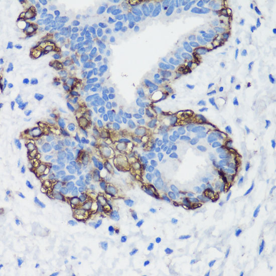 Immunohistochemistry of paraffin-embedded Human breast cancer using FLNA Polyclonal Antibody at dilution of  1:100 (40x lens).