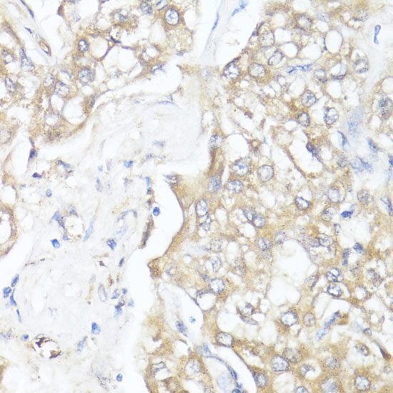 Immunohistochemistry of paraffin-embedded Human liver cancer using SMAD7 Polyclonal Antibody at dilution of  1:100 (40x lens).