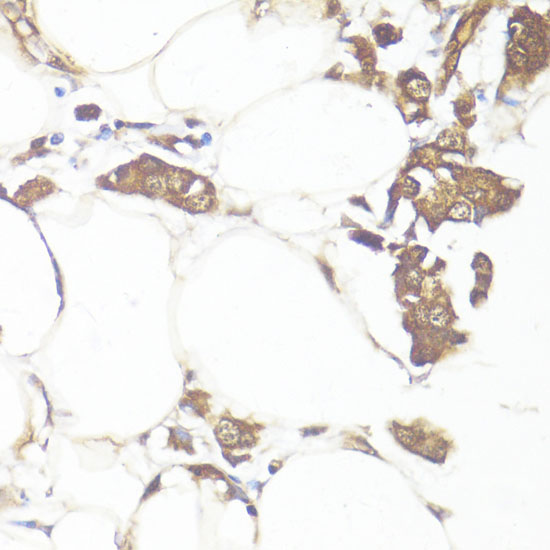 Immunohistochemistry of paraffin-embedded Human breast cancer using SMAD7 Polyclonal Antibody at dilution of  1:100 (40x lens).