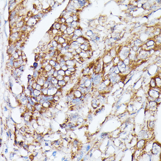 Immunohistochemistry of paraffin-embedded Human colon carcinoma using NUBP1 Polyclonal Antibody at dilution of  1:100 (40x lens).