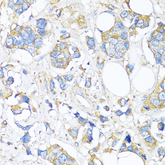 Immunohistochemistry of paraffin-embedded Human breast cancer using TIMP2 Polyclonal Antibody at dilution of  1:150 (40x lens).