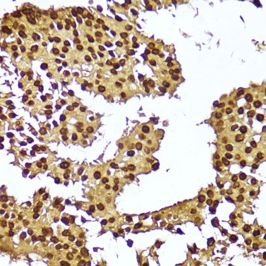 Immunohistochemistry of paraffin-embedded Human breast cancer using TERT Polyclonal Antibody at dilution of  1:100 (40x lens).