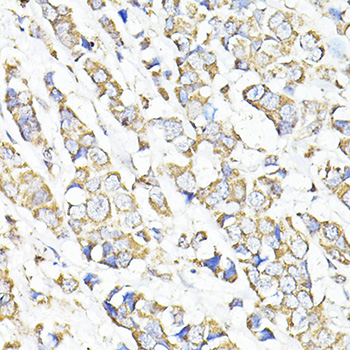 Immunohistochemistry of paraffin-embedded Human breast cancer using TGFB1 Polyclonal Antibody at dilution of  1:100 (40x lens).