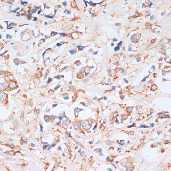 Immunohistochemistry of paraffin-embedded Human breast cancer using EIF4EBP1 Polyclonal Antibody at dilution of  1:100 (40x lens).