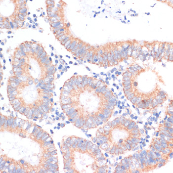 Immunohistochemistry of paraffin-embedded Human colon carcinoma using EIF4EBP1 Polyclonal Antibody at dilution of  1:100 (40x lens).