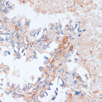 Immunohistochemistry of paraffin-embedded Human lung cancer using EIF4EBP1 Polyclonal Antibody at dilution of  1:100 (40x lens).