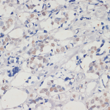 Immunohistochemistry of paraffin-embedded Human breast cancer using DNMT1 Polyclonal Antibody at dilution of  1:200 (40x lens).