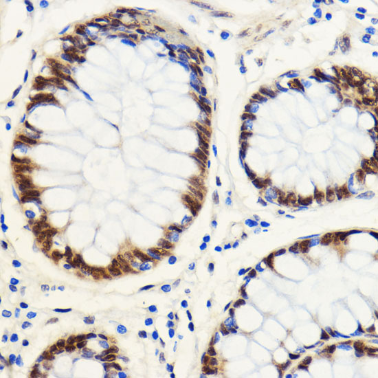 Immunohistochemistry of paraffin-embedded Human colon carcinoma using SNIP1 Polyclonal Antibody at dilution of  1:100 (40x lens).