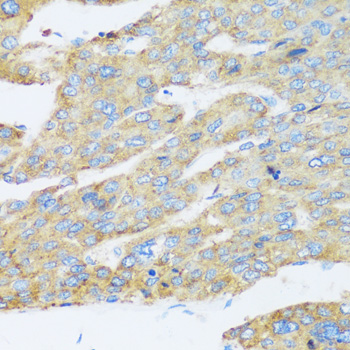 Immunohistochemistry of paraffin-embedded Human liver cancer using ASGR1 Polyclonal Antibody at dilution of  1:100 (40x lens).