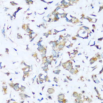 Immunohistochemistry of paraffin-embedded Human breast cancer using ATP5I Polyclonal Antibody at dilution of  1:100 (40x lens).