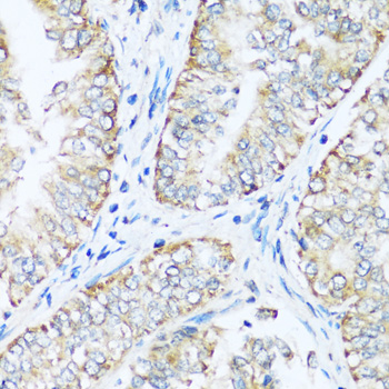 Immunohistochemistry of paraffin-embedded Human uterine cancer using ATP5I Polyclonal Antibody at dilution of  1:100 (40x lens).