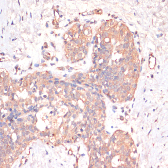 Immunohistochemistry of paraffin-embedded Human mammary cancer using Caspase-3 Polyclonal Antibody at dilution of  1:200 (40x lens).