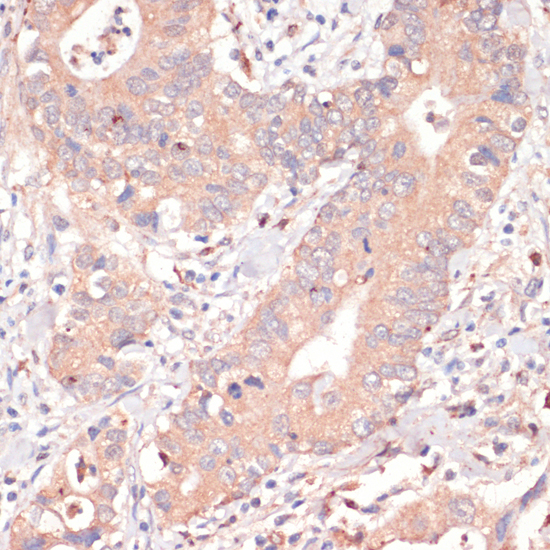 Immunohistochemistry of paraffin-embedded Human colon carcinoma using Caspase-3 Polyclonal Antibody at dilution of  1:200 (40x lens).