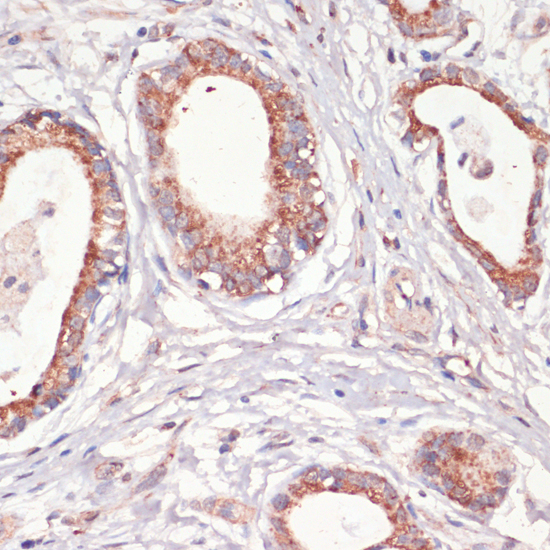 Immunohistochemistry of paraffin-embedded Human gastric cancer using Caspase-3 Polyclonal Antibody at dilution of  1:200 (40x lens).