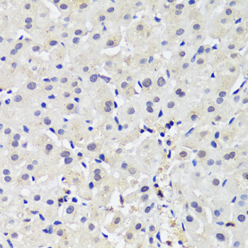 Immunohistochemistry of paraffin-embedded Human liver cancer using DNMT1 Polyclonal Antibody at dilution of  1:200 (40x lens).