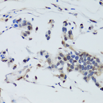 Immunohistochemistry of paraffin-embedded Human gastric cancer using DNMT1 Polyclonal Antibody at dilution of  1:200 (40x lens).