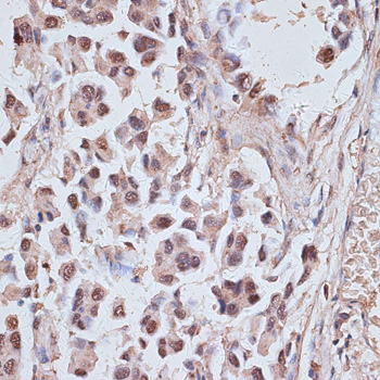 Immunohistochemistry of paraffin-embedded Human lung cancer using NR5A2 Polyclonal Antibody at dilution of  1:100 (40x lens).