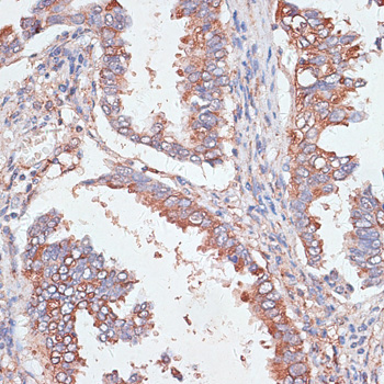 Immunohistochemistry of paraffin-embedded Human lung cancer using GAB1 Polyclonal Antibody at dilution of  1:100 (40x lens).