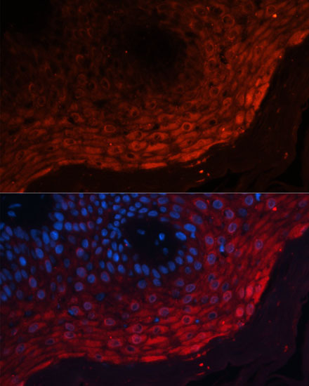 Immunofluorescence analysis of Human skin cancer using S100A8 Polyclonal Antibody at dilution of  1:100 (40x lens). Blue: DAPI for nuclear staining.