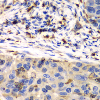 Immunohistochemistry of paraffin-embedded Human esophageal cancer using S100A8 Polyclonal Antibody at dilution of  1:100 (40x lens).
