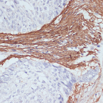 Immunohistochemistry of paraffin-embedded Human lung cancer using COL1A1 Polyclonal Antibody at dilution of  1:200 (40x lens).