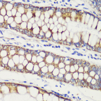 Immunohistochemistry of paraffin-embedded Human colon carcinoma using TOM20 Polyclonal Antibody at dilution of  1:100 (40x lens).