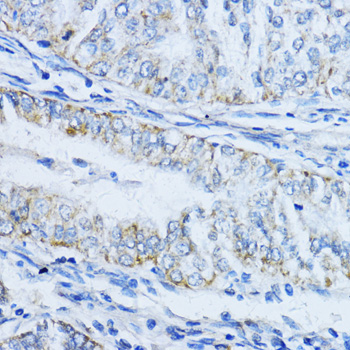 Immunohistochemistry of paraffin-embedded Human colon carcinoma using VIL1 Polyclonal Antibody at dilution of  1:100 (40x lens).