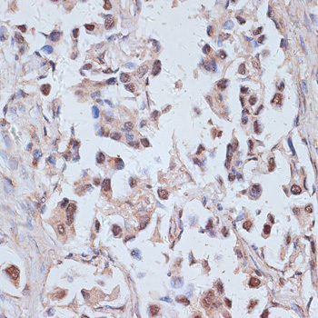 Immunohistochemistry of paraffin-embedded Human lung cancer using TAX1BP1 Polyclonal Antibody at dilution of  1:100 (40x lens).