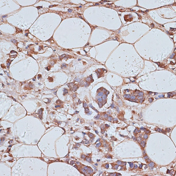 Immunohistochemistry of paraffin-embedded Human breast cancer using TAX1BP1 Polyclonal Antibody at dilution of  1:100 (40x lens).