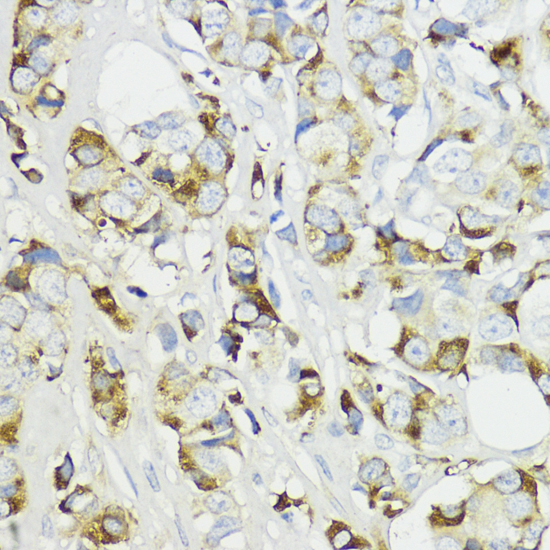 Immunohistochemistry of paraffin-embedded Human mammary cancer using Complement Factor B Polyclonal Antibody at dilution of  1:200 (40x lens).