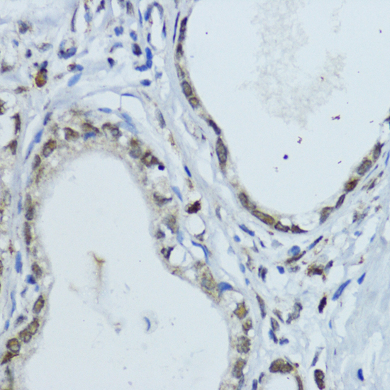 Immunohistochemistry of paraffin-embedded Human gastric cancer using NR1I3 Polyclonal Antibody at dilution of  1:200 (40x lens).