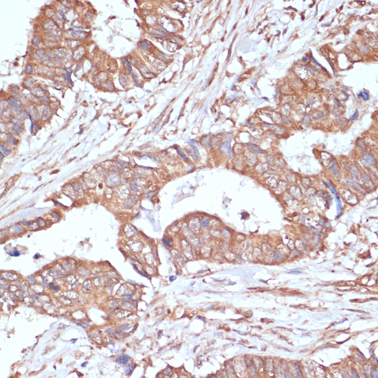 Immunohistochemistry of paraffin-embedded Human colon carcinoma using YAP1 Polyclonal Antibody at dilution of  1:100 (40x lens).