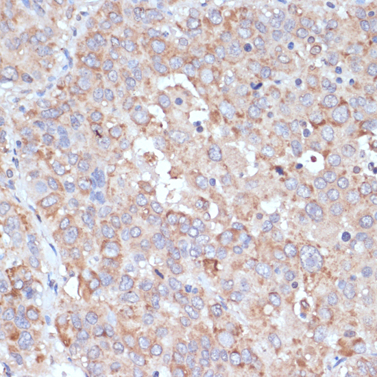 Immunohistochemistry of paraffin-embedded Human liver cancer using YAP1 Polyclonal Antibody at dilution of  1:100 (40x lens).