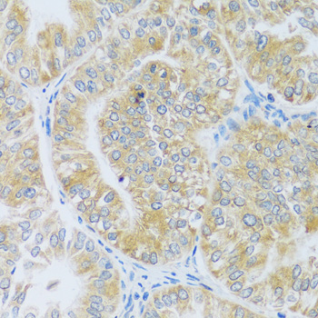 Immunohistochemistry of paraffin-embedded Human uterine cancer using ASB4 Polyclonal Antibody at dilution of  1:100 (40x lens).