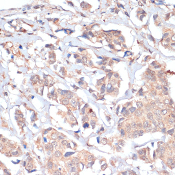 Immunohistochemistry of paraffin-embedded Human breast cancer using PRMT7 Polyclonal Antibody at dilution of  1:200 (40x lens).