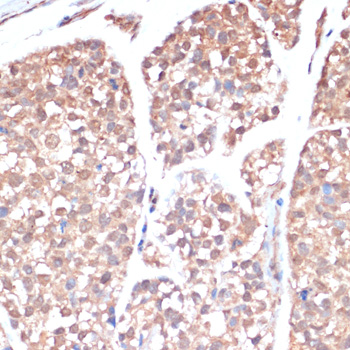 Immunohistochemistry of paraffin-embedded Human gastric cancer using PRMT7 Polyclonal Antibody at dilution of  1:200 (40x lens).